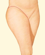 07_thigh-lift-outer-02