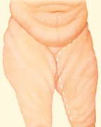 08_thigh-lift-medial-inc-01
