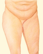 08_thigh-lift-medial-inc-02