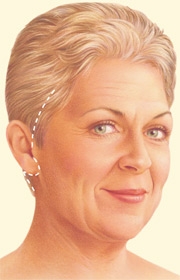 05_facelift-traditional-01