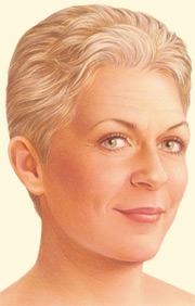 05_facelift-traditional-02