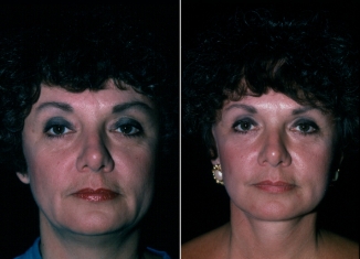 Facelift Patient 2