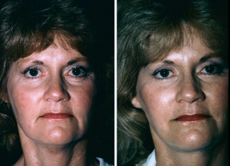 Facelift Patient 3