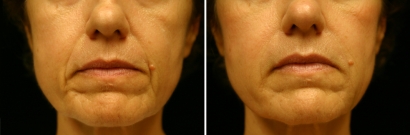 Juvéderm® Patient 2