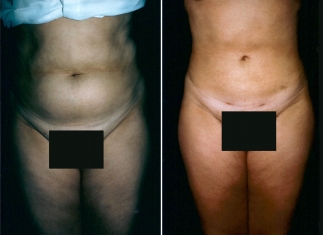 Liposuction Patient 1