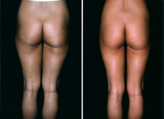 Liposuction Patient 4