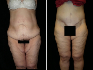 Lower Body Lift Patient 1
