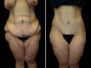 Lower Body Lift Patient 2