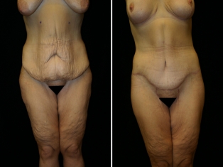 Lower Body Lift Patient 3