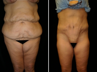Lower Body Lift Patient 4