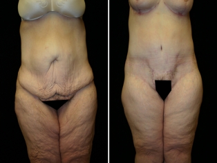 Lower Body Lift Patient 5