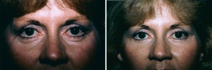 Upper & Lower Eyelid Lift Patient 1