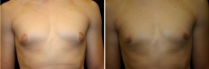 Male Breast Reduction Patient 1