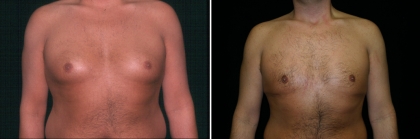 Male Breast Reduction Patient 2