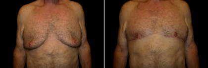Male Breast Reduction Patient 3