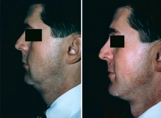 Neck Lift Patient 2