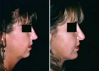 Neck Lift, Chin Implant Patient 1