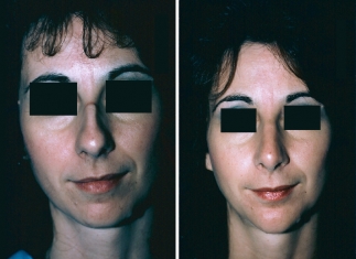 Rhinoplasty, Chin Implant Patient 1