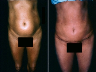 Tummy Tuck Patient 3