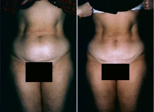Tummy Tuck Patient 4