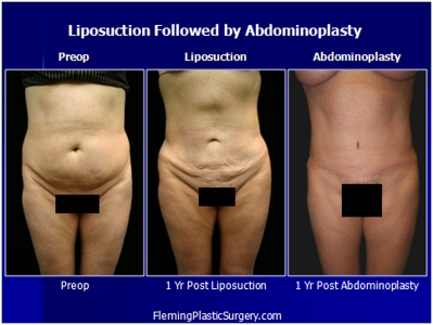 Tummy Tuck Patient 5