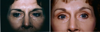 Upper & Lower Eyelid Lift, Brow Lift Patient 1
