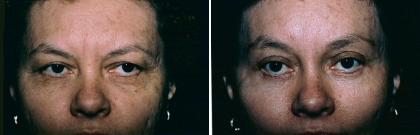 Upper & Lower Eyelid Lift, Brow Lift Patient 2