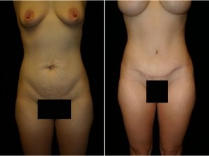 Tummy Tuck Patient 1