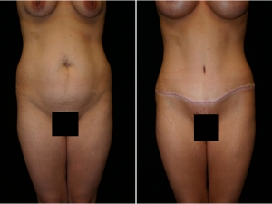 Tummy Tuck Patient 2