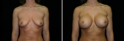 Breast Enlargement Patient 1