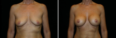 Breast Enlargement Patient 3