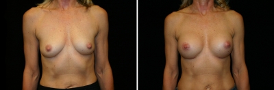 Breast Enlargement Patient 5