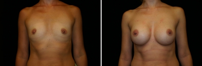 Breast Enlargement Patient 6