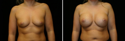 Breast Enlargement Patient 7
