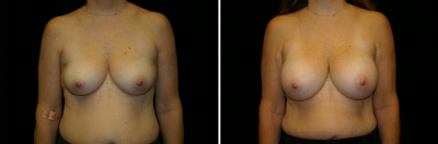 Breast Enlargement Patient 8