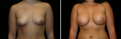 Breast Enlargement Patient 4