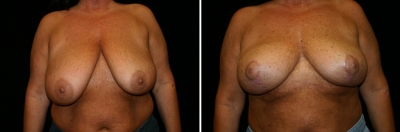 Breast Lift Patient 3