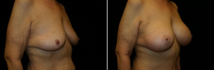 breast-lift-implant-01-02