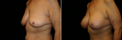 breast-lift-implant-01-04