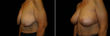 breast-lift-implant-02-04