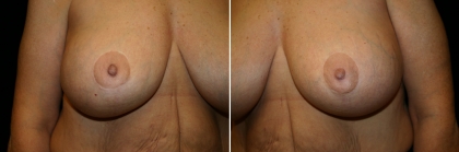 breast-lift-implant-02-06