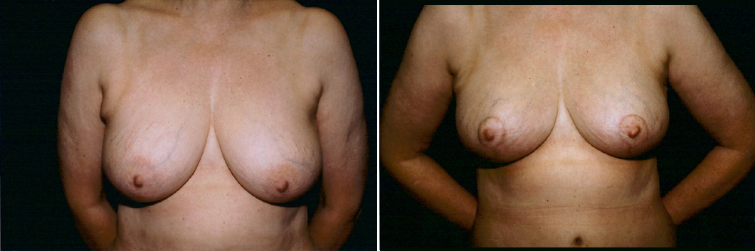 breast-mpxy-04-01