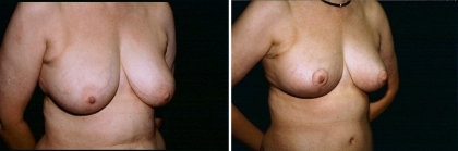 breast-mpxy-04-02