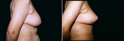 breast-mpxy-04-03