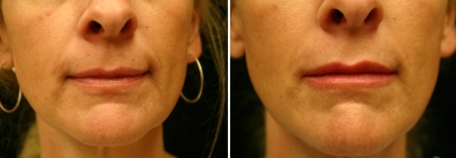 Filler Lip Enhancement Patient 1