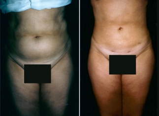 liposuction01-01