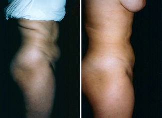 liposuction01-02