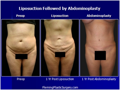 liposuction-abdominoplasty-002a