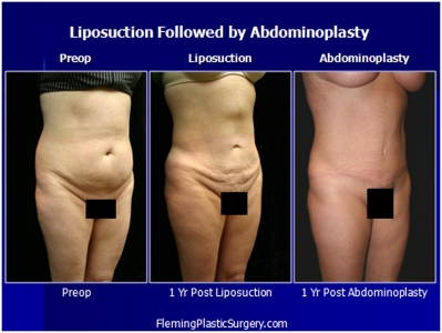 liposuction-abdominoplasty-002b