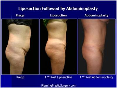 liposuction-abdominoplasty-002c